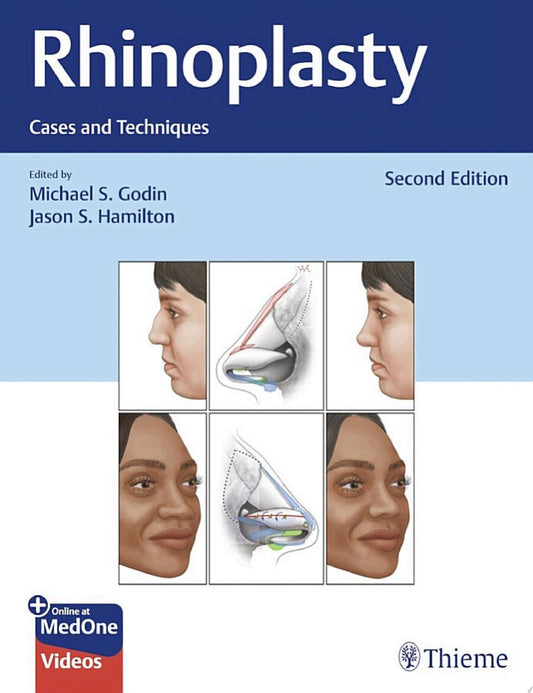 Rhinoplasty: Cases and Techniques